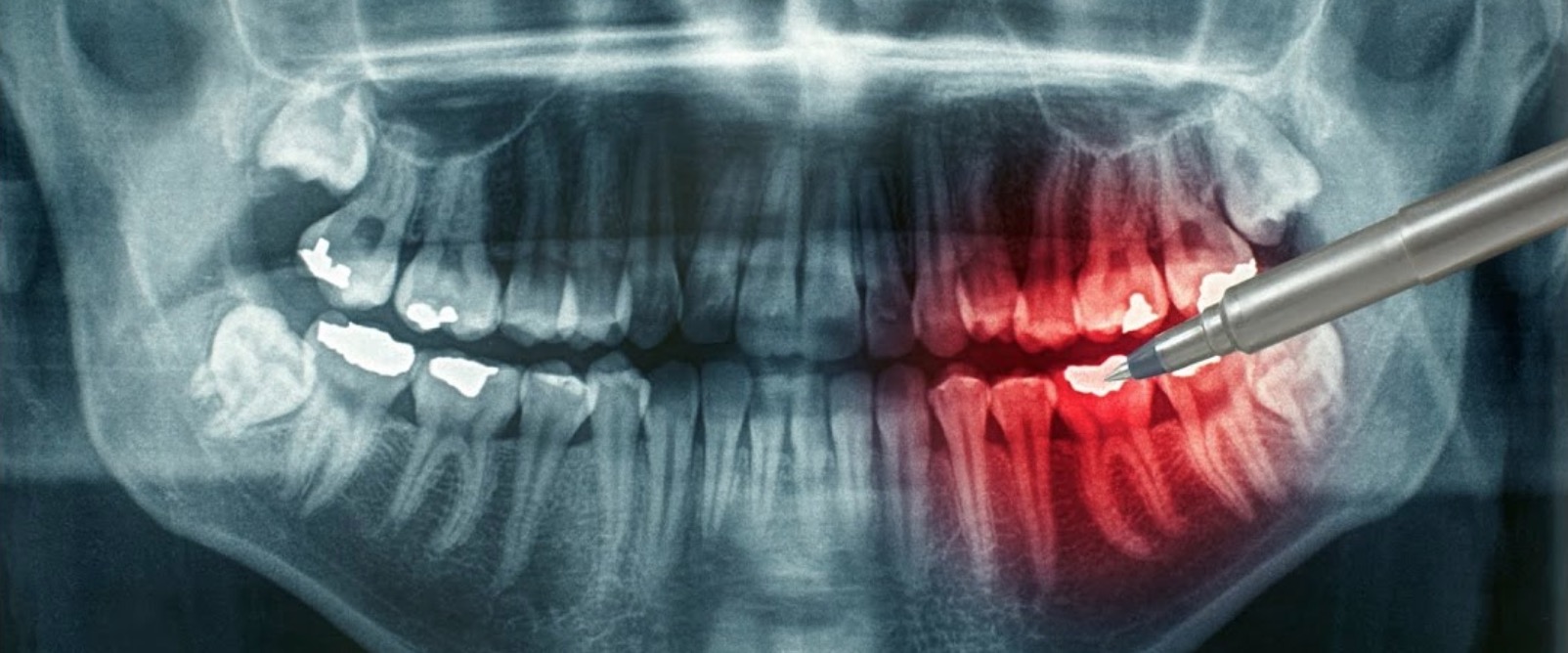 Как расшифровать рентген зуба?