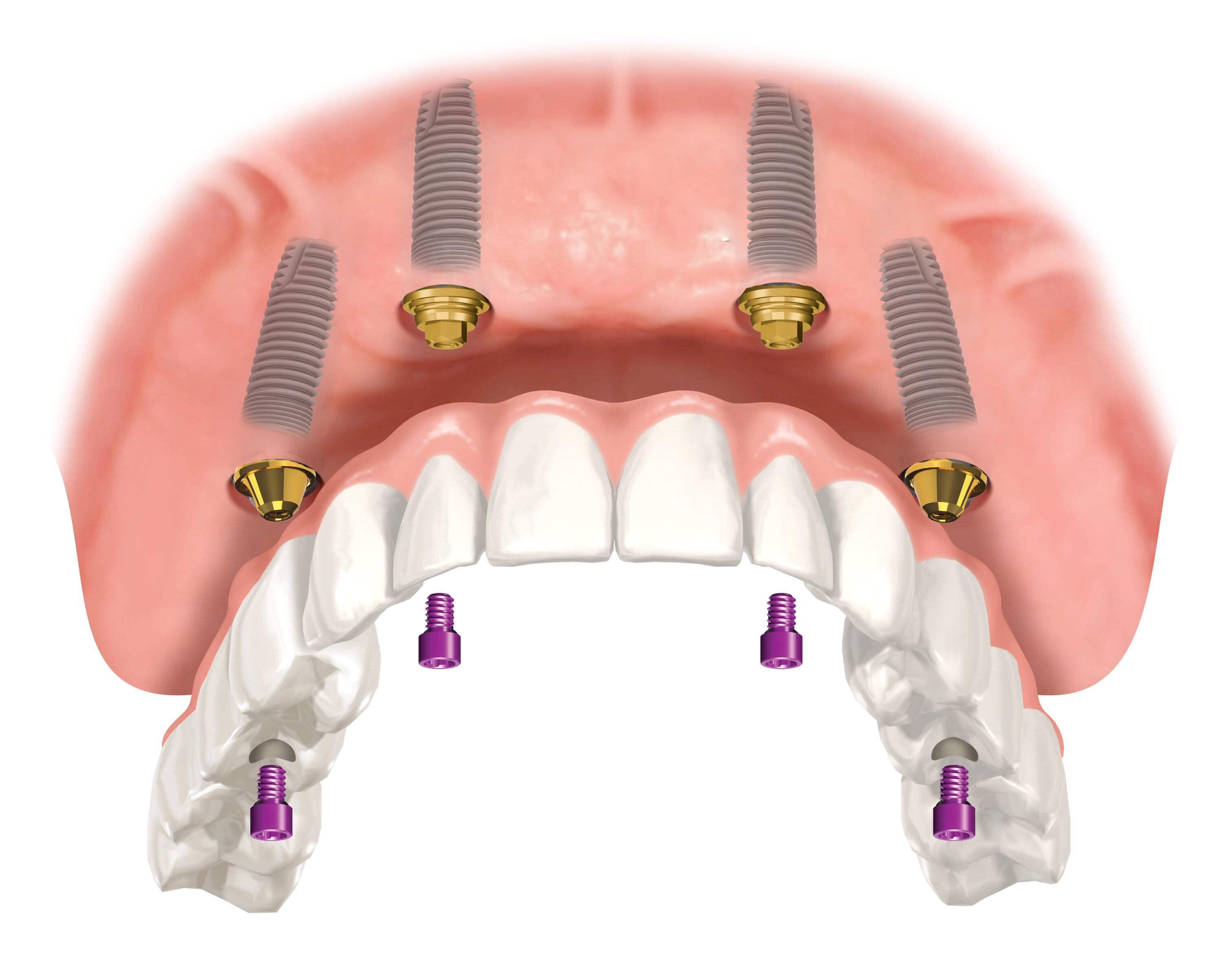 Протез на имплантах при полном отсутствии. Имплантологическая кассета Nobel полный набор для all on 4. Имплантация челюсти на 6 имплантах. Имплантация челюсти на 4 имплантах.