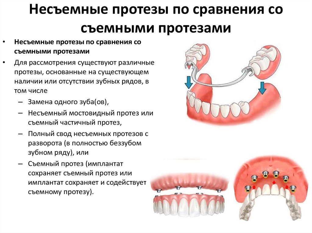 Какие зубные протезы лучше при отсутствии зубов. Съемные и несъемные протезы классификация. Несъемные зубные протезы. Несъемный протез на конструкции. Съемные и несъемные ортопедические конструкции.