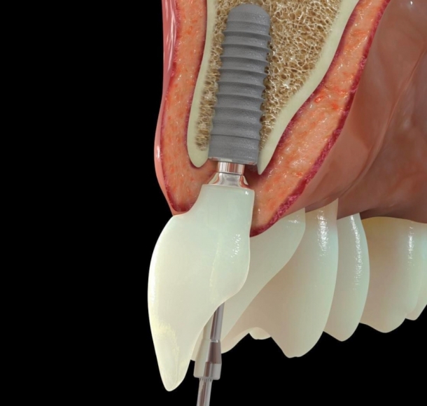 Зубные импланты. Стоматология Максима Шубных