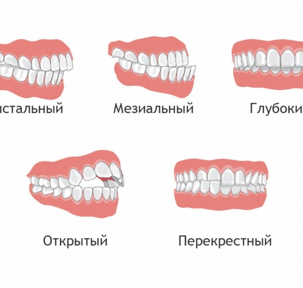 Исправление прикуса зубов. Стоматология Максима Шубных
