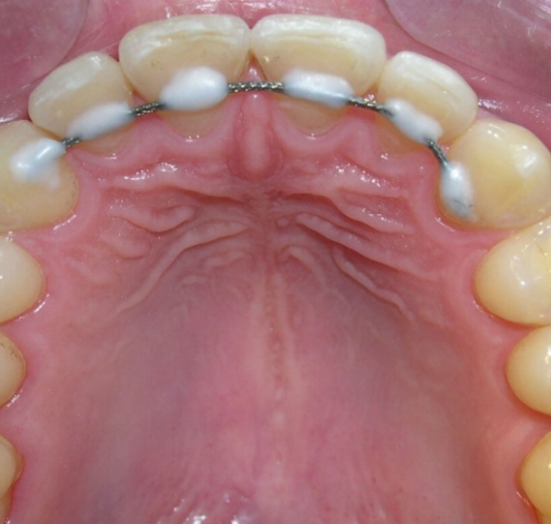 Шинирование зубов. Стоматология Максима Шубных