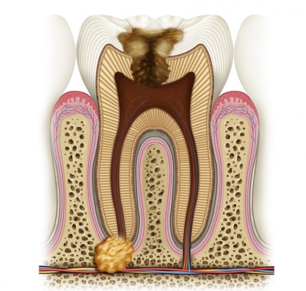Лечение гранулемы зуба. Стоматология Максима Шубных