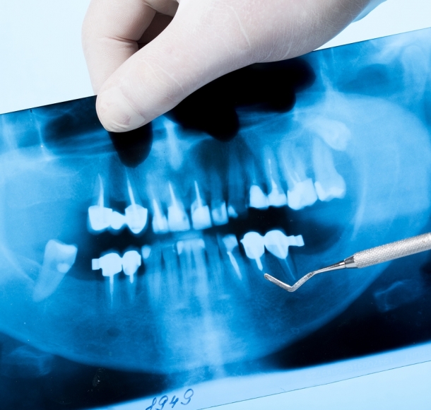 Рентгеновский снимок зуба. Стоматология Максима Шубных