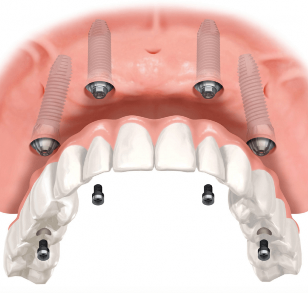 Имплантация при полном отсутствии зубов. Стоматология Максима Шубных