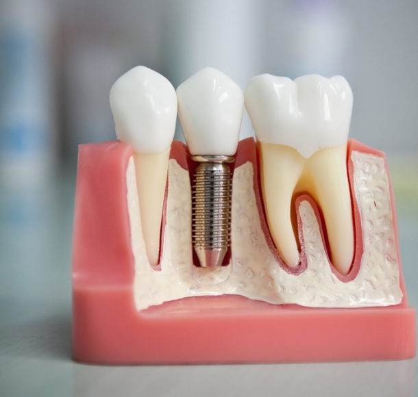 Имплантация зубов. Стоматология Максима Шубных