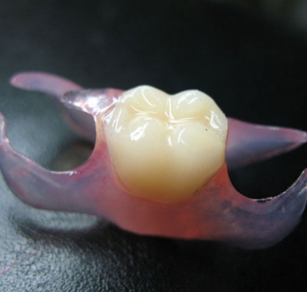 Зубной протез-бабочка. Стоматология Максима Шубных