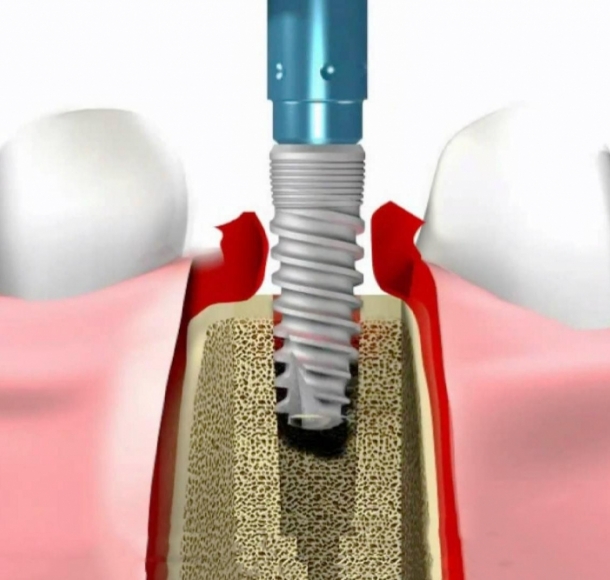 Одноэтапная имплантация зубов. Стоматология Максима Шубных