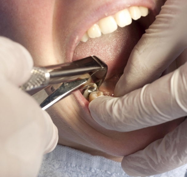 Удаление зуба мудрости. Стоматология Максима Шубных