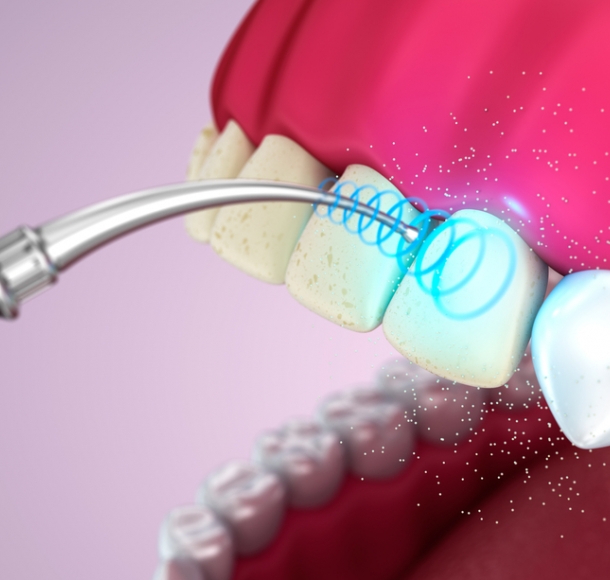 Ультразвуковая чистка зубов. Стоматология Максима Шубных