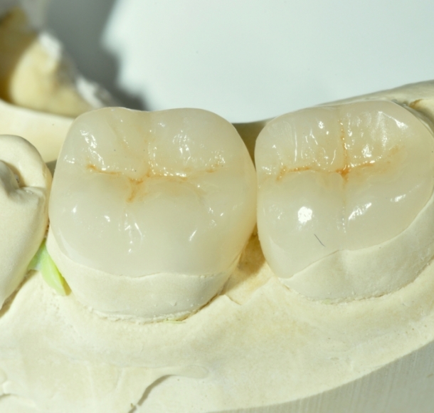 Зубные вкладки. Стоматология Максима Шубных